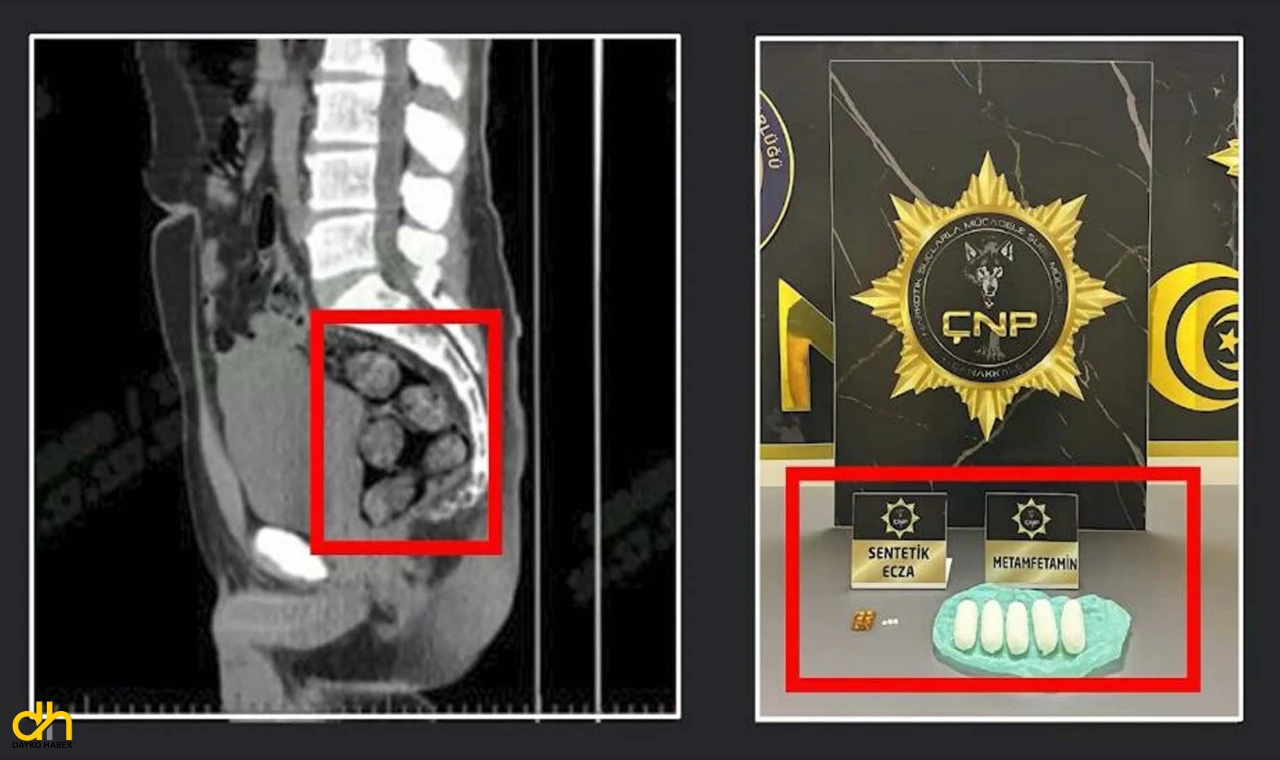 İran’dan gelen yolcu, midesinde 173,15 gram metamfetamin ile yakalandı