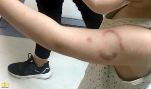 3 yaşındaki öğrencisinin kolunu ısıran öğretmen tutuklandı