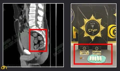 İran’dan gelen yolcu, midesinde 173,15 gram metamfetamin ile yakalandı